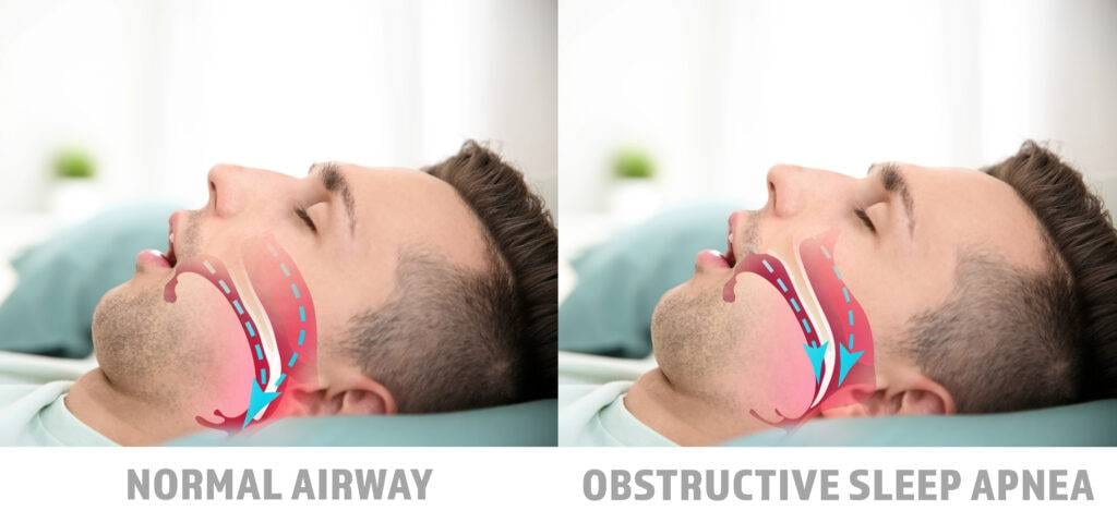 What is sleep apnea